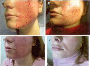 Stadien der Hautrestauration nach fraktionierter Ablation