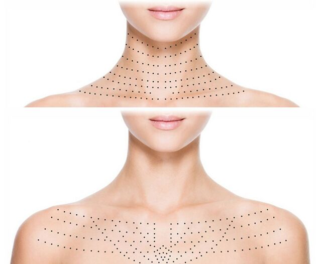 Markierung auf der Haut von Hals und Dekolleté zur verjüngenden Biorevitalisierung